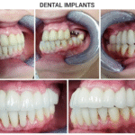 Best Dental Implants: A Complete Guide to Restoring Your Smile